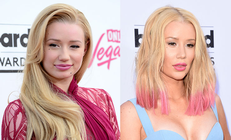 Iggy Azalea before (left) and after surgery.