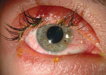 Fake lash glue can trigger allergic reactions. Photo: Royal Victorian Eye and Ear Hospital