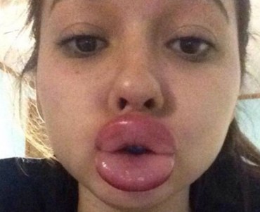 After thousands of girls began took part, Kylie Jenner was forced to admit her lips were fake. Photo: YouTube