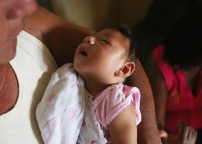 microcephaly zika virus