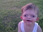The four-year-old suffers from pfeiffer syndrome.