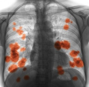 lung cancer breakthrough