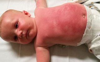 peppa-pig-sunscreen-burn