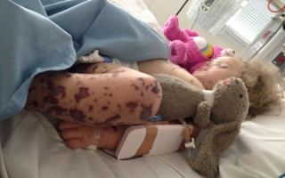 Young girl with meningococcal rash