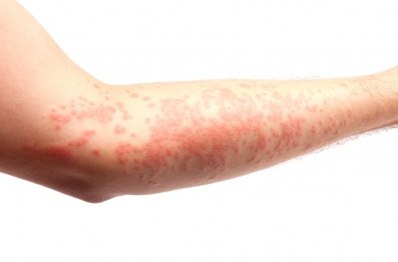An allergic reaction to a bee sting or wasp sting may result in a rash. 
