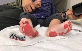 The toddler's feet were burnt at an Ipswich park.
