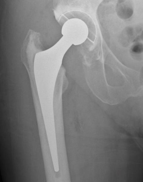 hip replacement x-ray