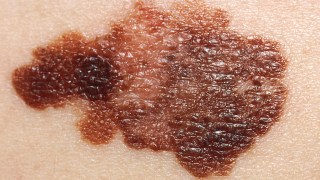 melanoma
