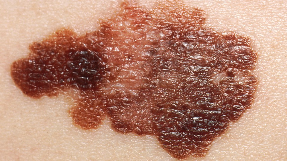 melanoma
